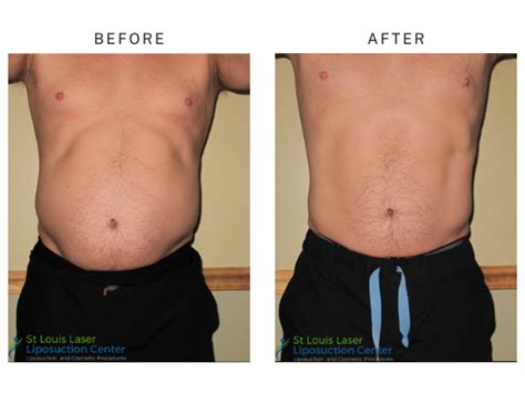 liposuction cost st louis|Liposuction – St. Louis, MO & Glen Carbon, IL – MidAmerica。